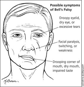 bells-palsy-symptoms